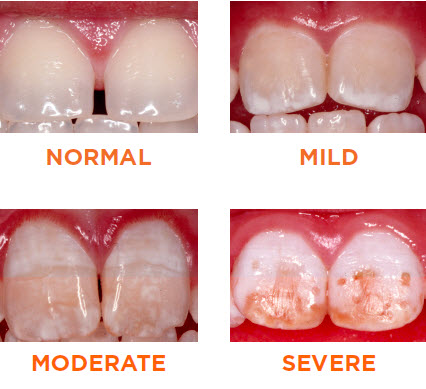 What is Fluorosis